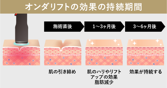 オンダリフト（オンダプロ）・オンダリフトボディ｜美容皮膚科・美容