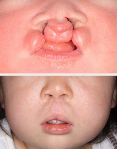 口唇裂・口蓋裂を出産前からケア 徳島大病院、8診療科が連携｜健康