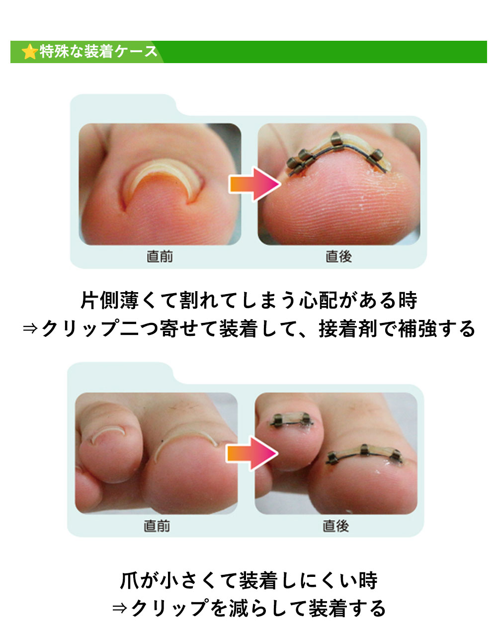 楽天市場】☆痛みにさようなら！☆毎日快適！巻き爪リフト まきづめ