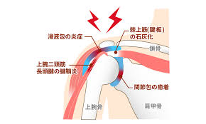肩関節周囲炎の正しいリハビリ【肩関節専門の理学療法士が教えます