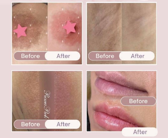 ビフォーアフターあり】ローマピンクで、くすみケア革命！自然なピンク