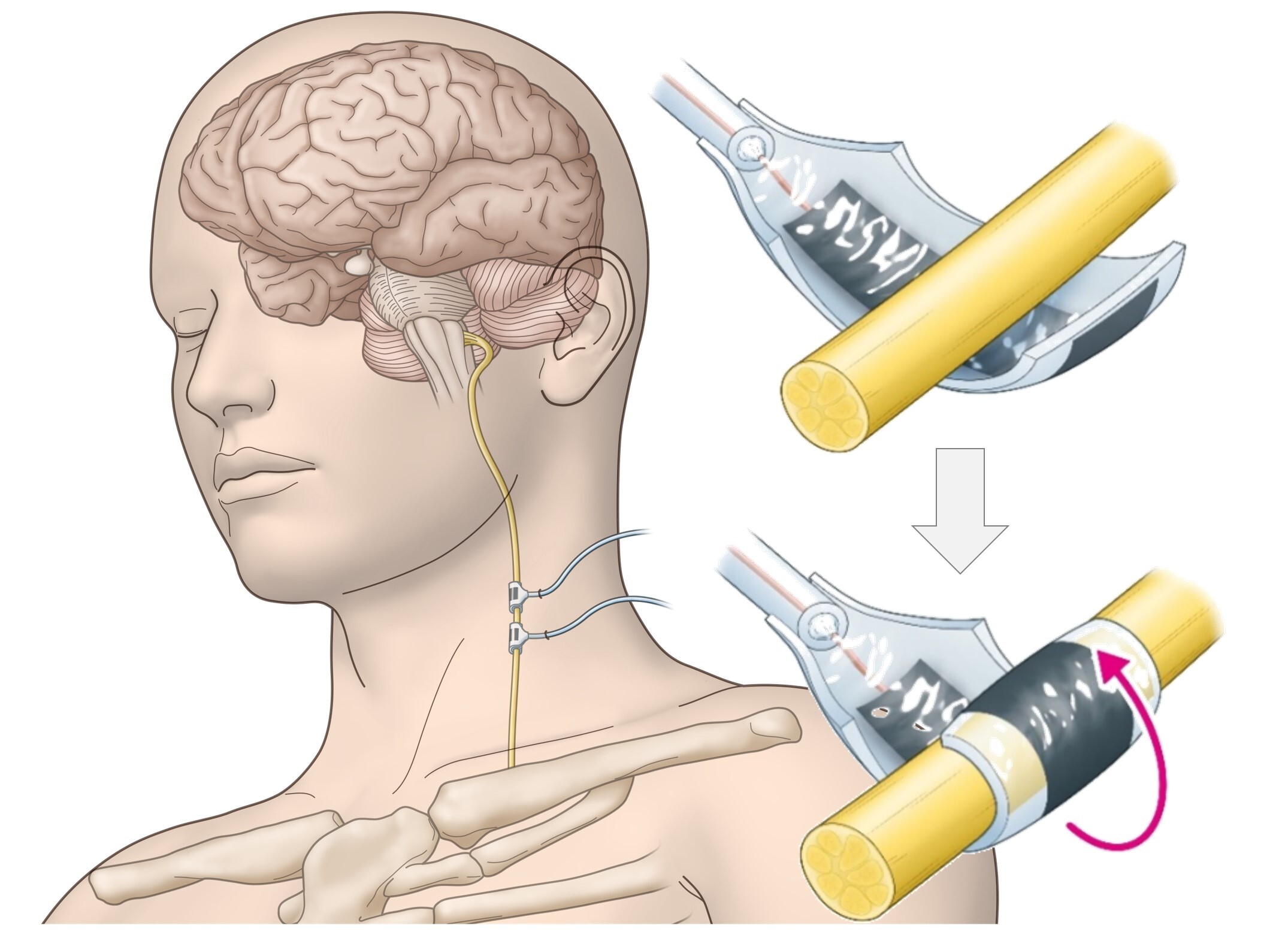 神経に柔らかく巻付くオール有機物のゲル電極 ～迷走神経刺激に有用な