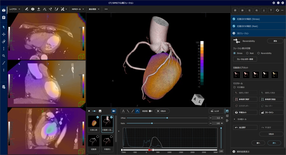 アプリケーション（心臓領域） | REVORAS