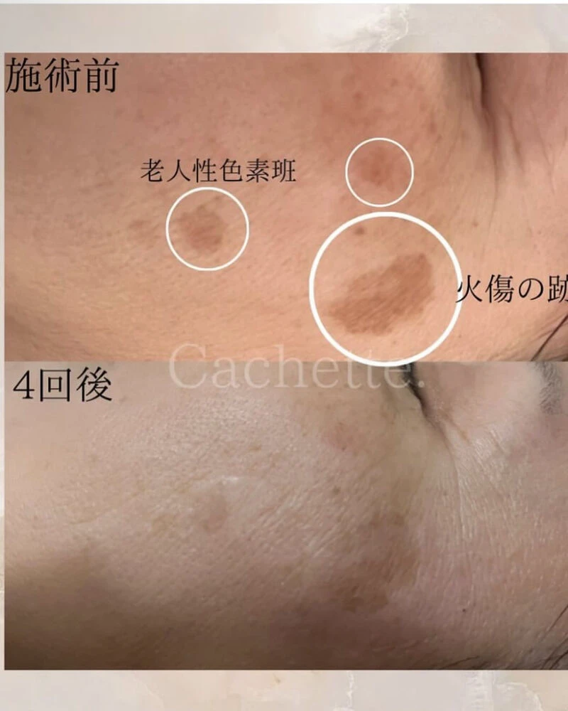 低周波最新シミケアコース | ブログ | 愛知県碧南市のエステならCachette.