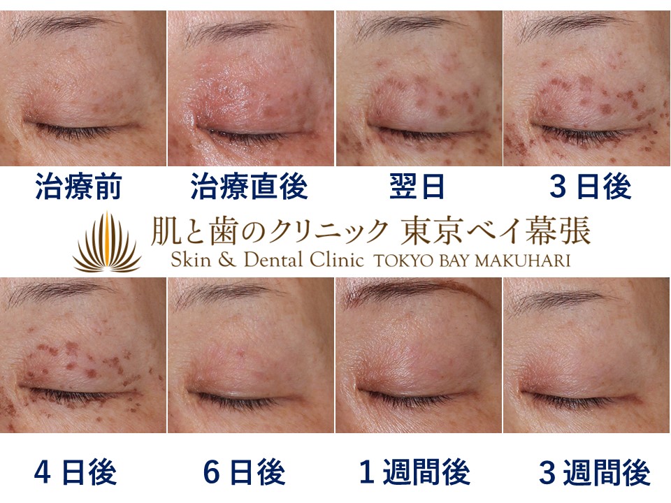 症例写真 | 目元のシミにお悩みの方へ朗報！目周り・瞼のシミ取り放題