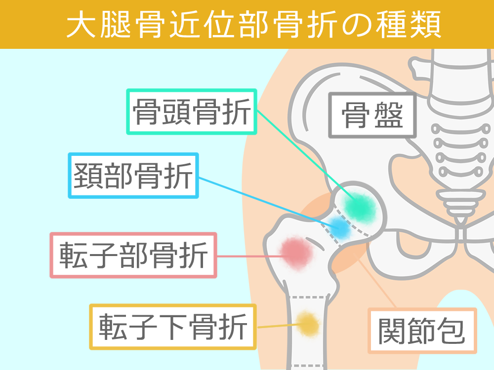 高齢者の大腿近位部部骨折における訪問看護に求められる視点と支援の