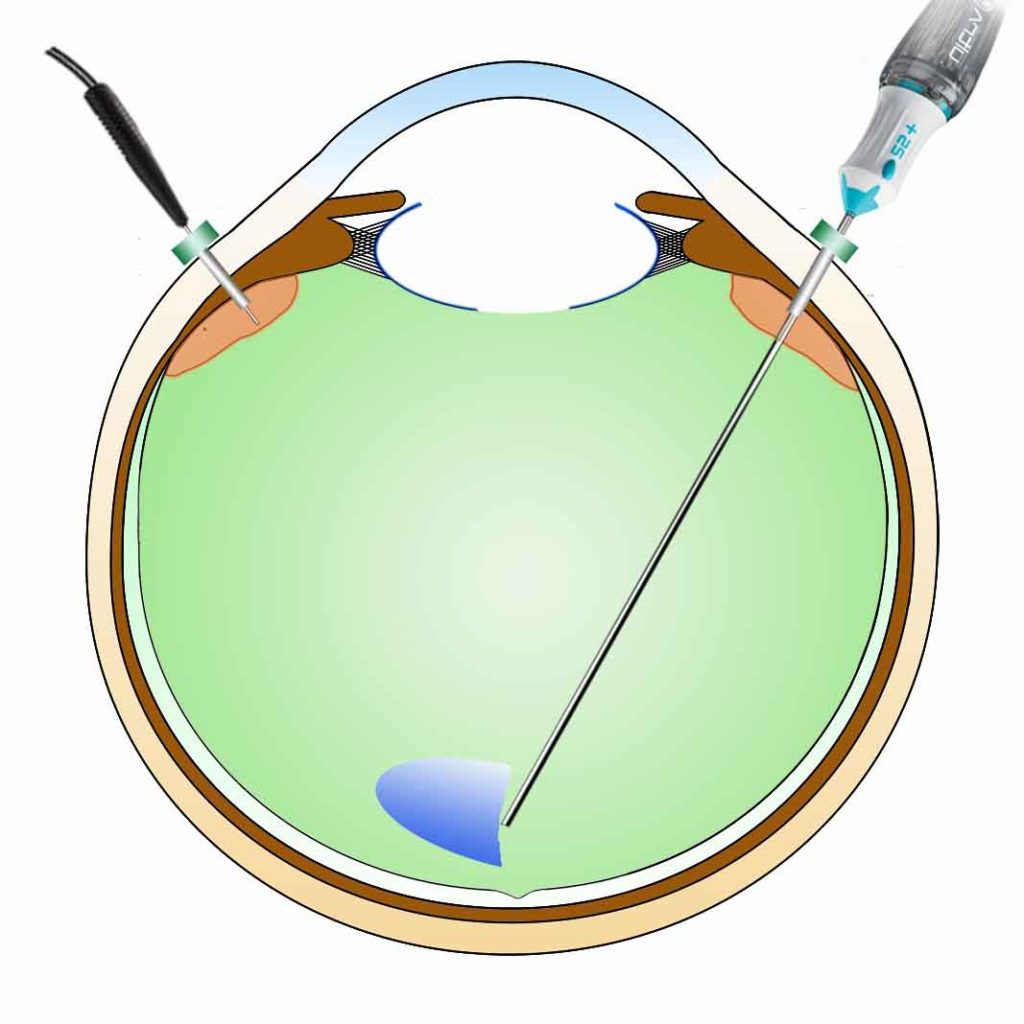 硝子体手術 - 亀谷アイクリニック