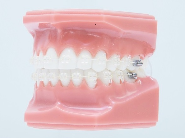 矯正装置 | 南柏駅から徒歩すぐ・南柏かんだ矯正歯科