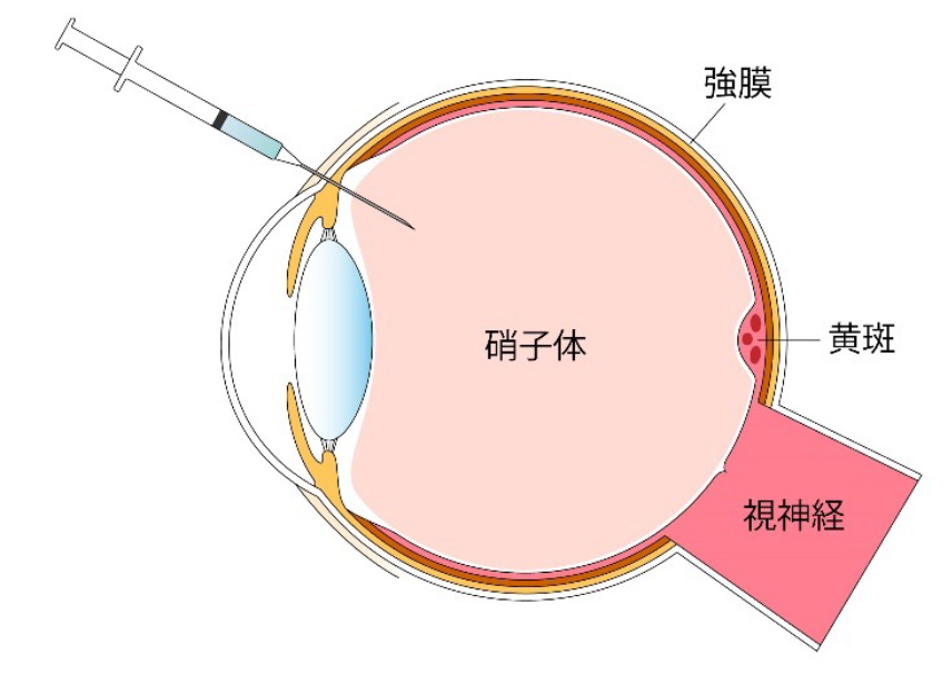 糖尿病網膜症の治療・手術方法｜茨城県水戸市の小沢眼科内科病院