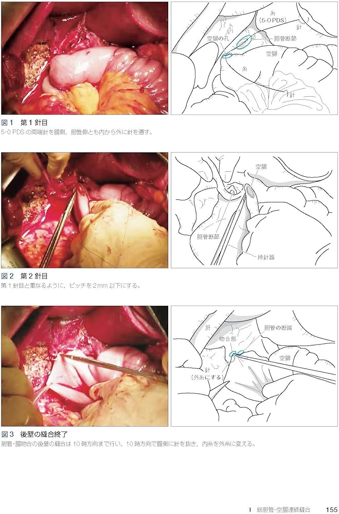 消化管吻合法バイブル [Web動画付] | 北島 政樹 |本 | 通販 | Amazon