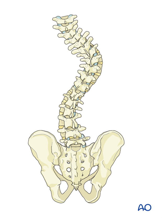Posterior Screws - No direct vertebral body derotation for Lenke 3