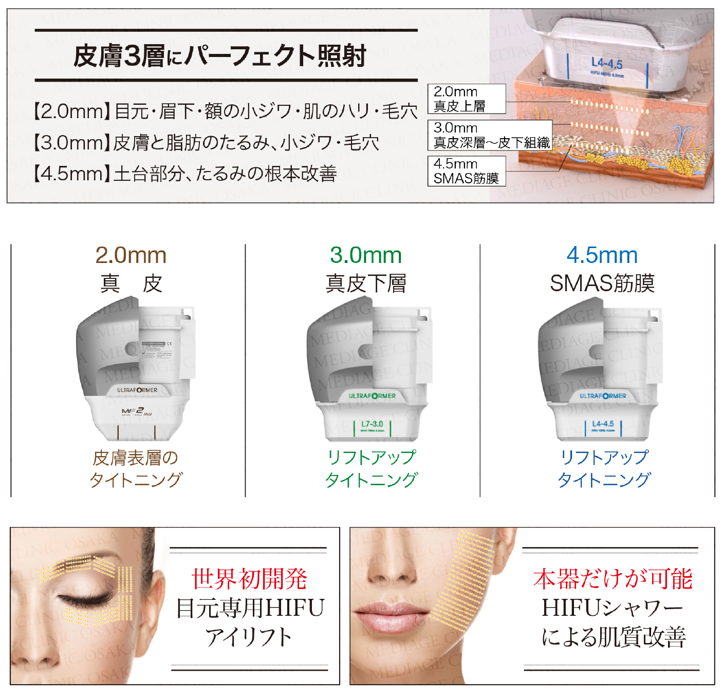 ウルトラフォーマー | メディアージュクリニック大阪梅田院 | 美容皮膚
