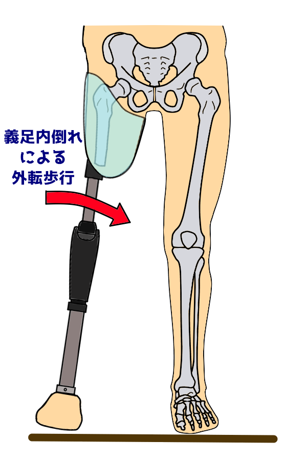 PTOT国家試験解説 大腿義足のアライメント | なぜなに。装具 まとめ