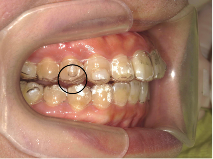 効率的に矯正治療！】振動型の矯正治療効果促進装置について【スマイル