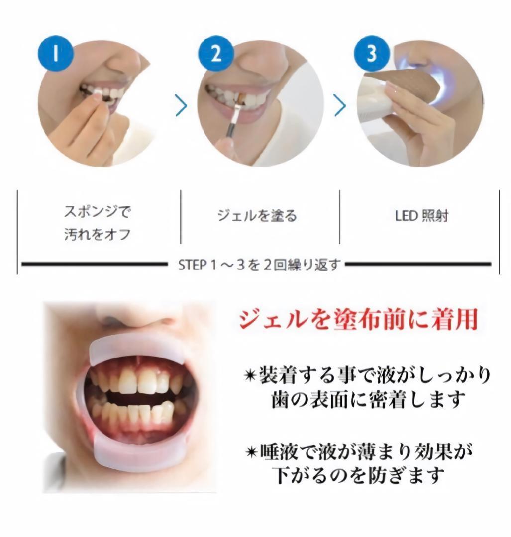 ホワイトニングに最適】マウスオープナー/開口器/歯科用 青色 リ