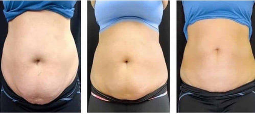 脂肪冷却マシン4ハンドル【送料込み/税別】 | ALL in ONE