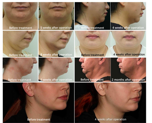 脂肪冷却マシン4ハンドル【送料込み/税別】 | ALL in ONE